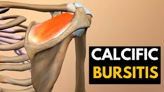 Calcific Bursitis Causes Signs and Symptoms Diagnosis and Treatment [upl. by Thera]