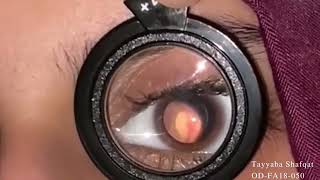 Fundoscopy using 20D lens Demonstration  Optometry  TUF [upl. by Auqinehs]