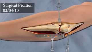 3D Surgical Animation of Elbow Injury [upl. by Kurtz]