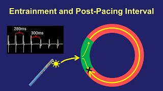 Entrainment Mapping The PostPacing Interval [upl. by Anaert462]