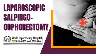 Laparoscopic Salpingooophorectomy for Recurrent Endometrioma A Comprehensive Video Overview [upl. by Camilo]