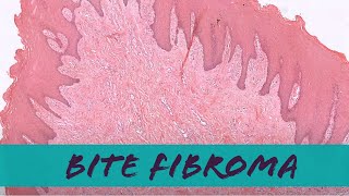 Bite fibroma in mouth aka irritation fibromaoral fibroma pathology dermpath dermatology [upl. by Libby451]