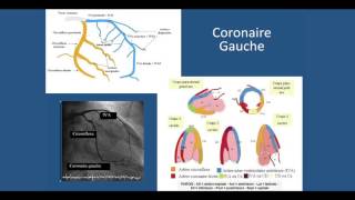 Coronarographie et Angioplastie coronaire [upl. by Wichern930]