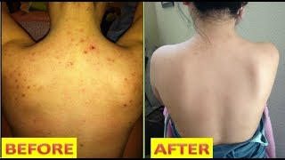 GET RID OF BACK ACNE IN JUST 7 DAYS  100 EFFECTIVE HOME REMEDY  youtube [upl. by Santiago]