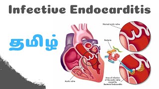 Infective Endocarditis In Tamil  Clinical Cardio Tamil Lecture [upl. by Kathrine]