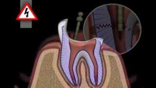 Tooth Core Build Up [upl. by Iridissa]