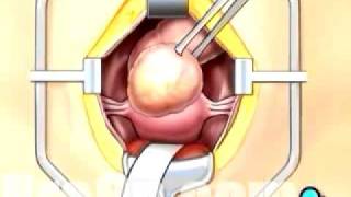 PreOp® Patient Education Myomectomy Abdominal Fibroid Removal Surgery [upl. by Fronia]