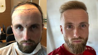 Hair Transplant Before and After  Month by Month Results  Elithair [upl. by Eelirem]