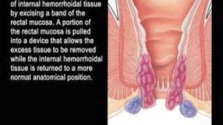 procedure for prolapsing hemorrhoids [upl. by Curkell]