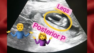 13 weeks oregnant gender reveal  posterior placenta means baby boygirl  how to tell gender on usg [upl. by Nickie]