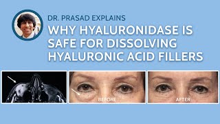 How Hyaluronidase Injections to Remove Filler is Done Safely [upl. by Ileana]