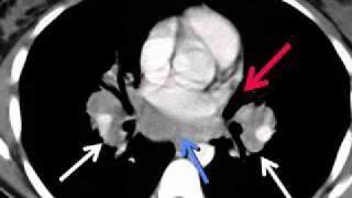 LearningRadiology 55 Sarcoidosis [upl. by Geiss]