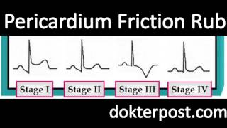 pericardium friction rub [upl. by Ettenot]