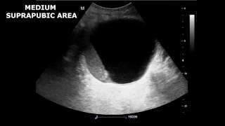 Renal Ultrasound in Etiology of Acute Kidney Failure  A Case Report [upl. by Caddric]