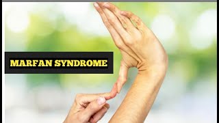 marfan syndrome [upl. by Pliam]