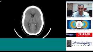 Subarachnoid Hemorrhage radiology teaching by Dr Arjun Kalyanpur [upl. by Abie]