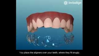 What is Invisalign [upl. by Nilcaj894]