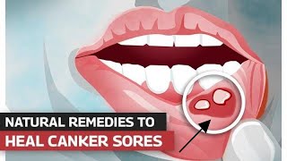 How To Treat Canker Sores  Mouth Sores Treatment [upl. by Trebled]