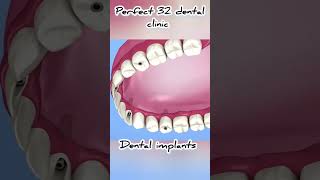 dental implants meditation medical dental trend [upl. by Zoe504]