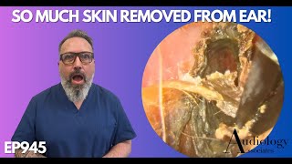 SO MUCH SKIN REMOVED FROM PATIENTS EAR CANAL  EP945 [upl. by Ahsimed]