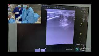 Preemptive vs Postoperative Ultrasoundguided mandibular nerve block  Video abstract ID 290462 [upl. by Eatnohs906]