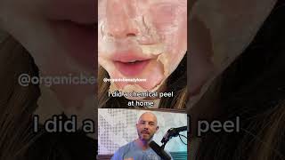 Reacting to this chemical peel thats done at home 🫣 credit organicbeautylover on TT [upl. by Yeleen]