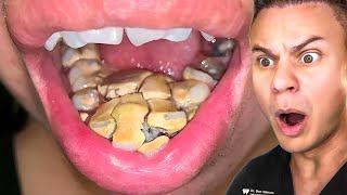 Orthodontist Reacts To Disgusting Teeth Cleanings [upl. by Buchbinder]