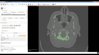 Step 1 Segment CT in Slicer [upl. by Dnomhcir117]