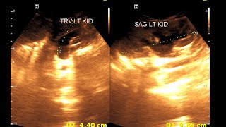 Bilateral hydro nephrosis  Bilateral dilated ureter  Renal Ultrasonography [upl. by Ohl572]