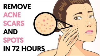 How to Get Rid of Acne Scars and Spots in 72 Hours [upl. by Vic]