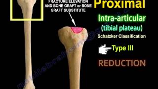 Tibial Plateau Fracture Fixation Proximal Tibia  Everything You Need To Know  Dr Nabil Ebraheim [upl. by Adelice792]