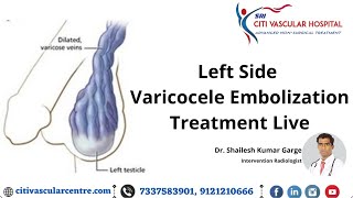 Varicocele Embolization Treatment Live  Varicocele Surgery Honest Video  Varicocele Specialist [upl. by Cirillo]