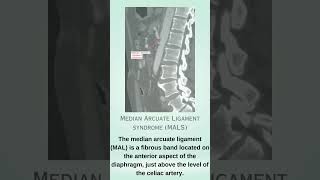 Median arcuate ligament syndrome  MALS [upl. by Zanahs]