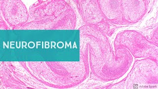 Neurofibroma Neurofibromatosis1 and Low Grade MPNST [upl. by Snyder]