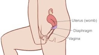 Diaphragm The Hidden Secret to HormoneFree Birth Control [upl. by Enyamrahc]