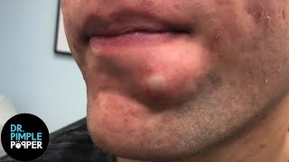 SATISFYING Dr Lee Pops Inflamed Cyst on Chin  Dr Pimple Popper Reacts [upl. by Sikleb562]