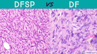 DFSP vs DF dermatofibrosarcoma protuberans vs dermatofibroma pathology dermatology dermpath [upl. by Osnofla715]