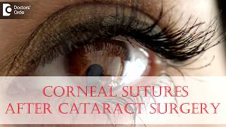 Why are corneal sutures given after Cataract Surgery  Dr Sriram Ramalingam [upl. by Abbotsun723]