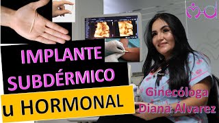 IMPLANTE SUBDERMICO U HORMONAL POR GINECOLOGA DIANA ALVAREZ [upl. by Mylo190]