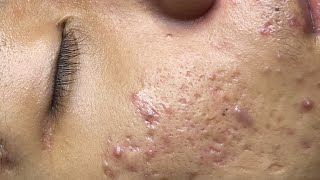 ACNE TREATMENT VU QUYNH MI Blackheads Removal On Boy Face 2024 [upl. by Bruis]