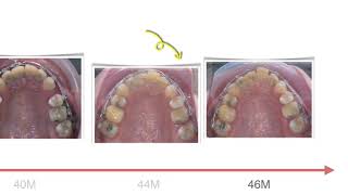 Class II Treatment with U1 Ankylosis｜【Chris Chang Ortho】CC755 [upl. by Constanta]