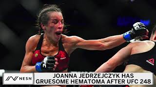 Joanna Jedrzejczyk Suffers Gruesome Hematoma At UFC 248 [upl. by Vanni]