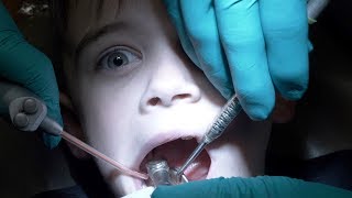 DENTAL HEALTH VLOG  HIS FIRST CAVITY FILLING  TWO CAVITIES [upl. by Byran]