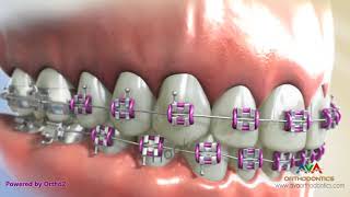 Orthodontic Braces  Different Parts 2 [upl. by Richmond]