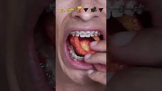 what happens when you eat spicy chips with braces [upl. by Servetnick]