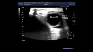 Epididymal Cyst Hydrocele and Inguinal Hernia [upl. by Airetnahs663]