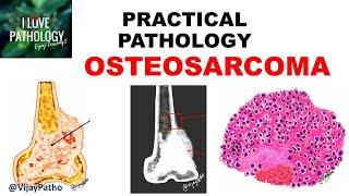 OSTEOSARCOMA Clinical  Radiological features amp Morphology [upl. by Creight998]