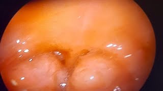 Tonsillectomy  Tonsil Surgery  Is Tonsil Surgery necessary  ENT specialist  Tonsils [upl. by Hauhsoj]