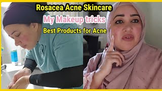 How i Treat my Rosacea acne skin👍No makeup loks Acne issues [upl. by Kanal]