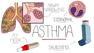 Asthma Explained Including Pathophysiology [upl. by Artapoelc12]